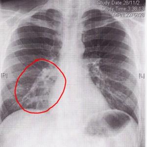 Coughing Up Thick White Phlegm - Bronchitis Organization And Information To Manage This Particular Disorder