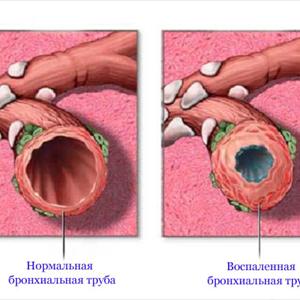 Yoga Position To Help Bronchitis - Types Of Lung Cancer