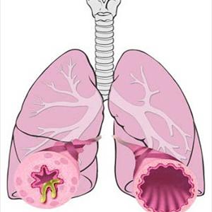 Bronchial Infections - Causes - Bacterial Might Be The Cause Of Bronchitis