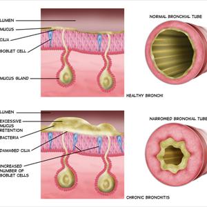 Otc Meds For Bronchitis - Mortality Charges Linked To Smoking