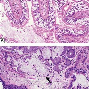  Bronchitis Therapeutics 