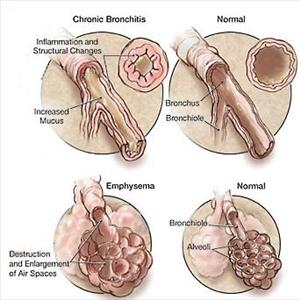 Nac For Asthma And Bronchitis - Information On Bronchitis