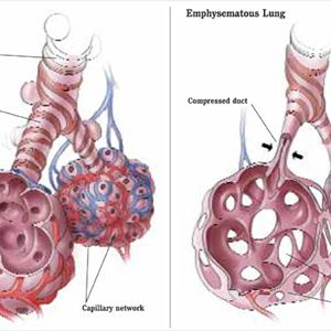 Remedies For Bronchitis - How Used Smoke Threatens Your Health