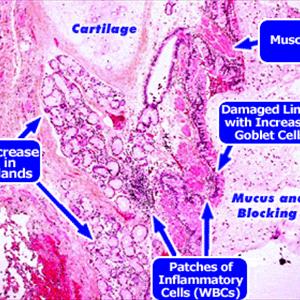 Bronchitis Cause - Deadly Diseases - Primarily Brought On By Excessive Cigarette Smoking