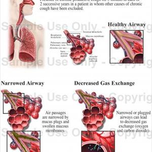 Herbal Treatments For Chronic Broncitus - Learn To Treat Bronchitis Naturally Within Seven Days