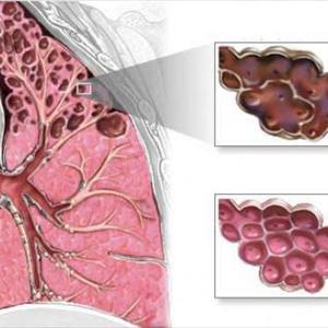 Acute Bronchitis Natural Treatment - Useful Pointers In Looking For Treating Persistent Bronchitis