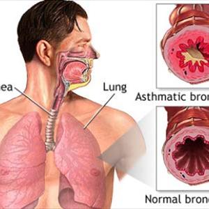  Bronchitis 