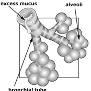 Natural Antibiotic For Broncial Ailments - Deadly Diseases - Primarily Brought On By Too Much Cigarette Smoking