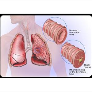 Chronic Bronchitis Natural Healing - About Prescribing Antibiotics For Acute Bronchitis