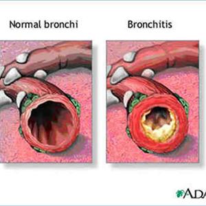 Who Sells Bronovil - Giving Up Smoking - And The Radioactive Components In Cigarettes!