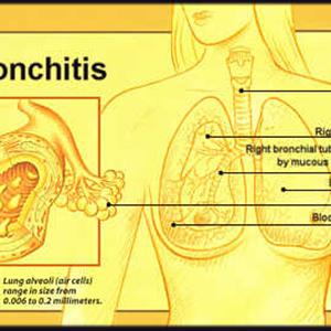  Bronchitis Pictures