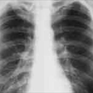 Coughing Up Thick White Phlegm - Bronchitis Firm And Information To Manage This Kind Of Disorder