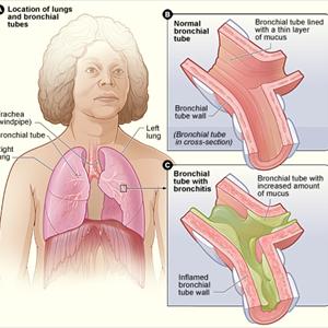 Bronovil African Pelagoniam - Information About Bronchitis