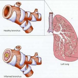 Cure For Chronic Bronchitis 