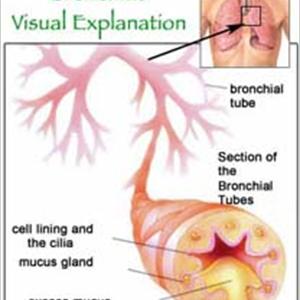 Bronchitis Cough And Smoking 