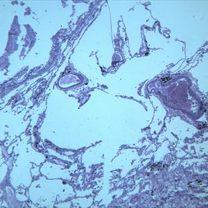 Bronchitis Cough And Smoking - Using NLP To Be Able To Defeat COPD