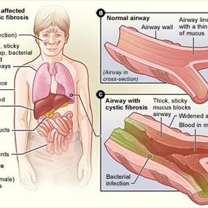 Bronkial Mucus And Caugh - Why Holistic Cures Sometimes Fail