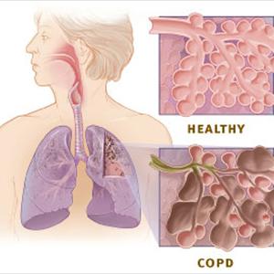 Bronchitis And Prednisone - Tracheal Bronchitis