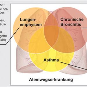 Preventing Bronchitis - Giving Up Smoking - And The Radioactive Components Within Cigarettes!