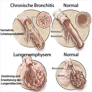 Continuous Coughing With Phlegm - Better And Herbal Treatment For Bronchitis Natural Remedies