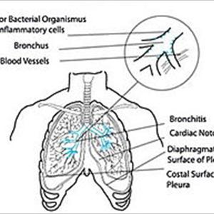 Herbal Treatments For Chronic Broncitus - Learn To Treat Bronchitis Naturally Inside Seven Days