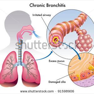 Broncitisinfections - Bacterial May Trigger Bronchitis