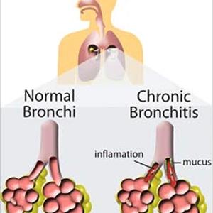 Chest X-Ray For Bronchitis - Fast Acting Bronchodilator Albuterol Is One Of The Oldest Bronchial Asthma Treatment Drugs